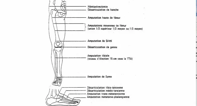 amputation-membres-inferieurs lieu exact de l'amputation dans une jambe