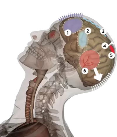 traumatisme-cranien-avocats-400×466 trauma crânien